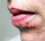 הרפס גניטלי - תמונת אווירה